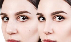 Rhinoplasty Surgery in Bhubaneswar